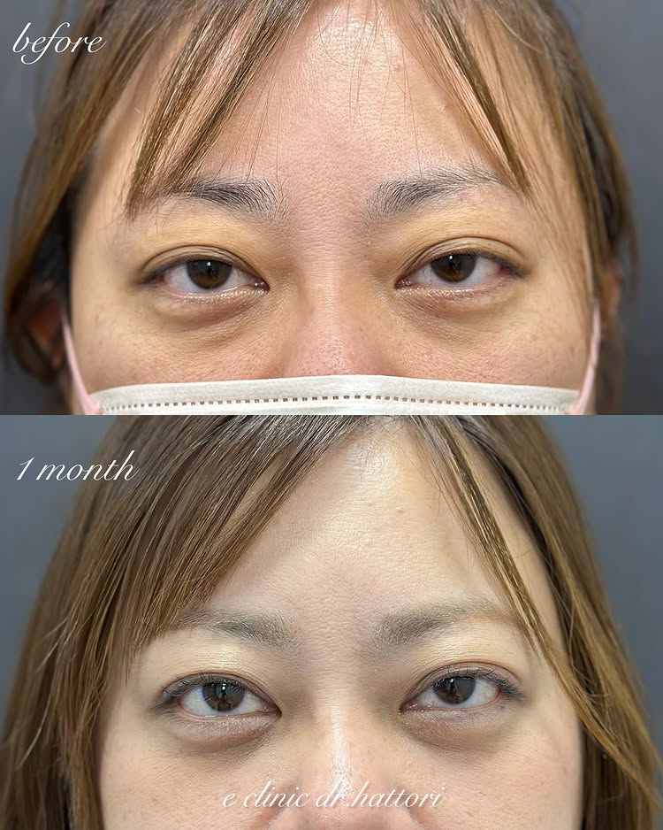 裏ハムラ法の症例写真 (60)