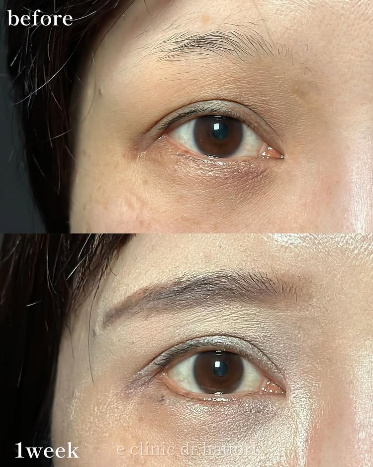 タレ目形成の症例写真 (31)