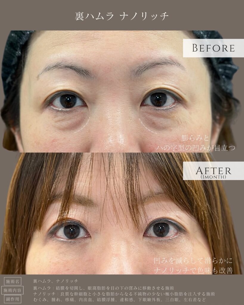 裏ハムラ法とナノリッチの症例写真 (18)