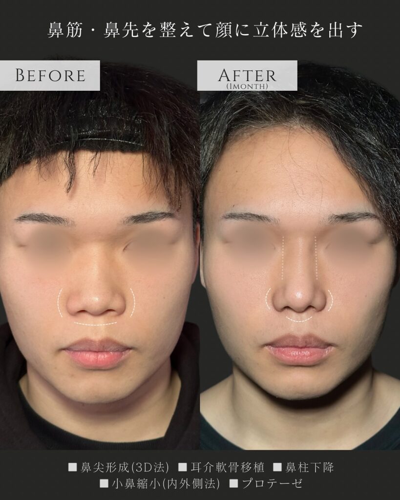 鼻尖形成と耳介軟骨移植と鼻柱下降と小鼻縮小とプロテーゼの症例写真 (2)