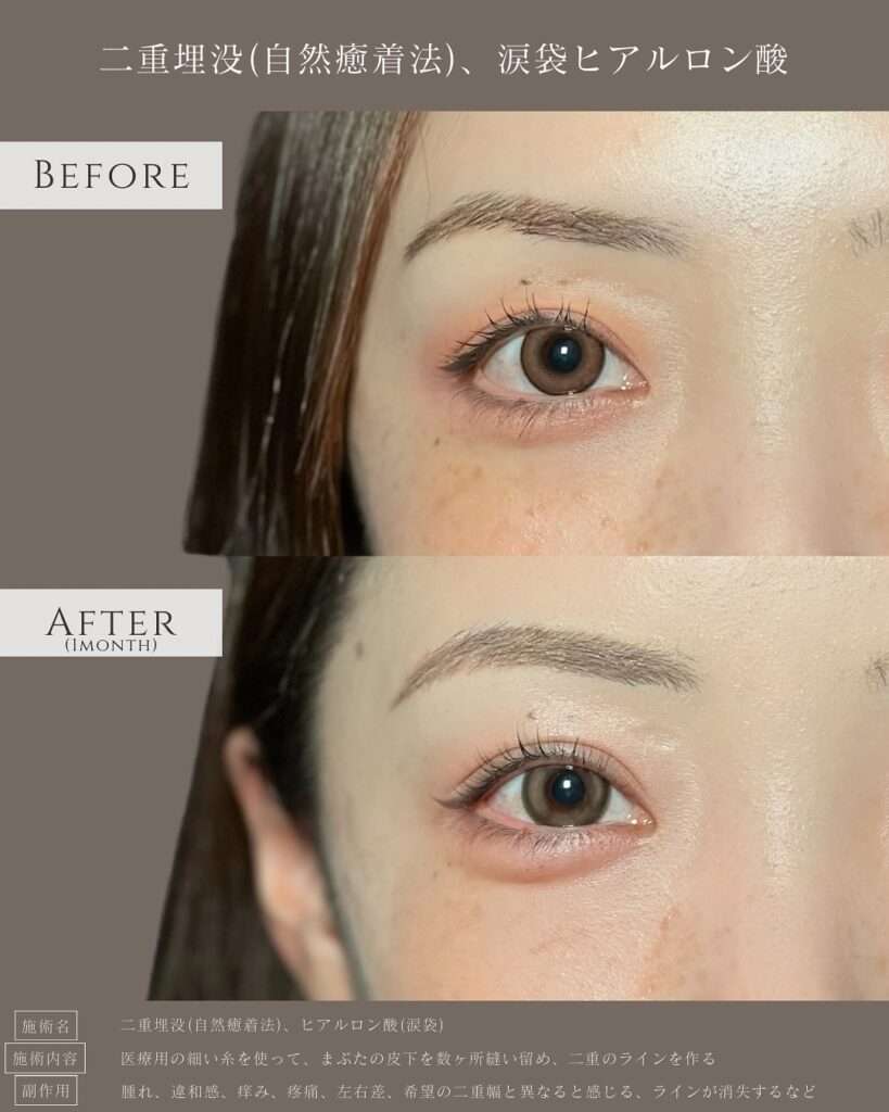自然癒着法と涙袋のヒアルロン酸の症例写真 (4)
