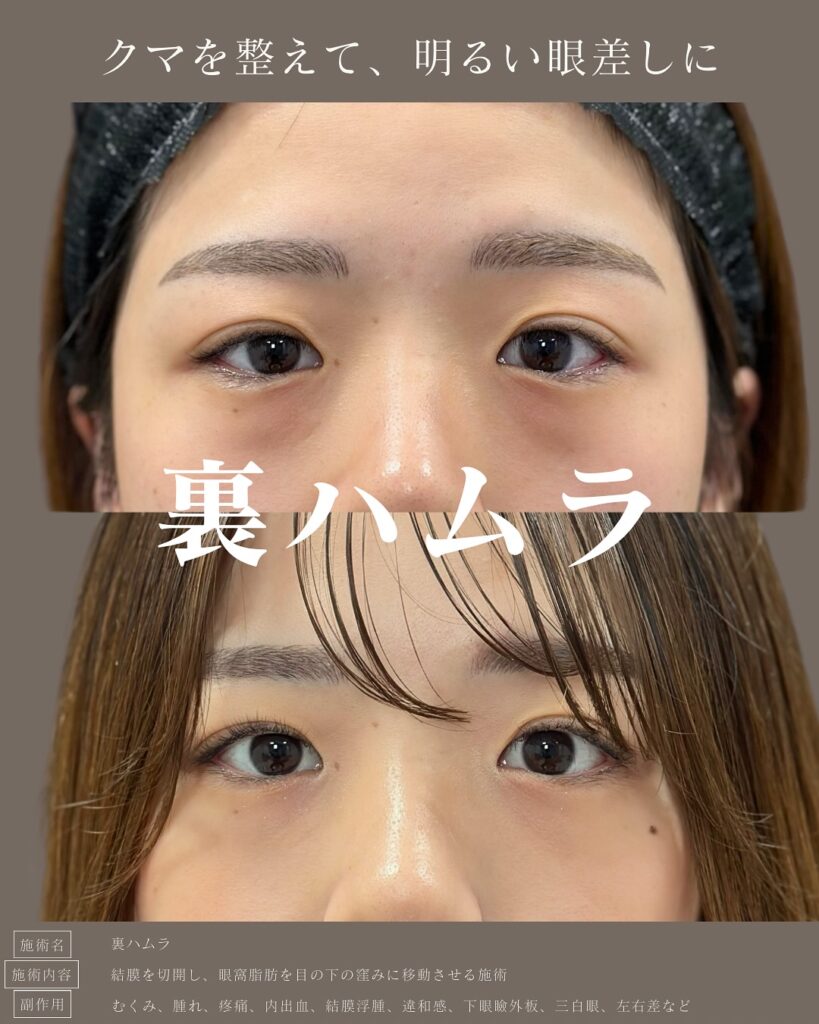 裏ハムラ法の症例写真 (20)