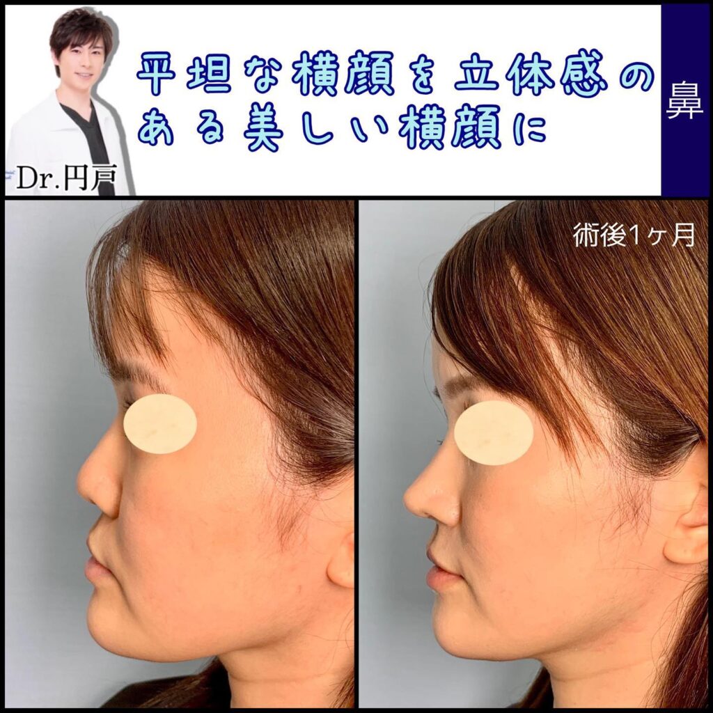 鼻の美容整形の症例写真
