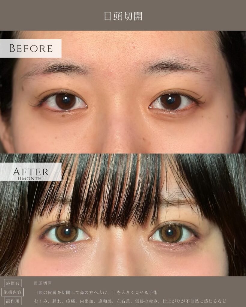 目頭切開の症例写真 (2)