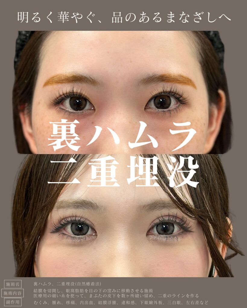 裏ハムラ法と自然癒着法の症例写真 (1)