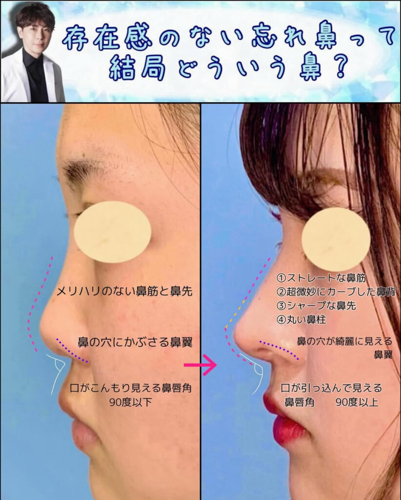 鼻中隔延長と鼻尖形成と軟骨移植と小顔脂肪吸引の症例写真 (2)