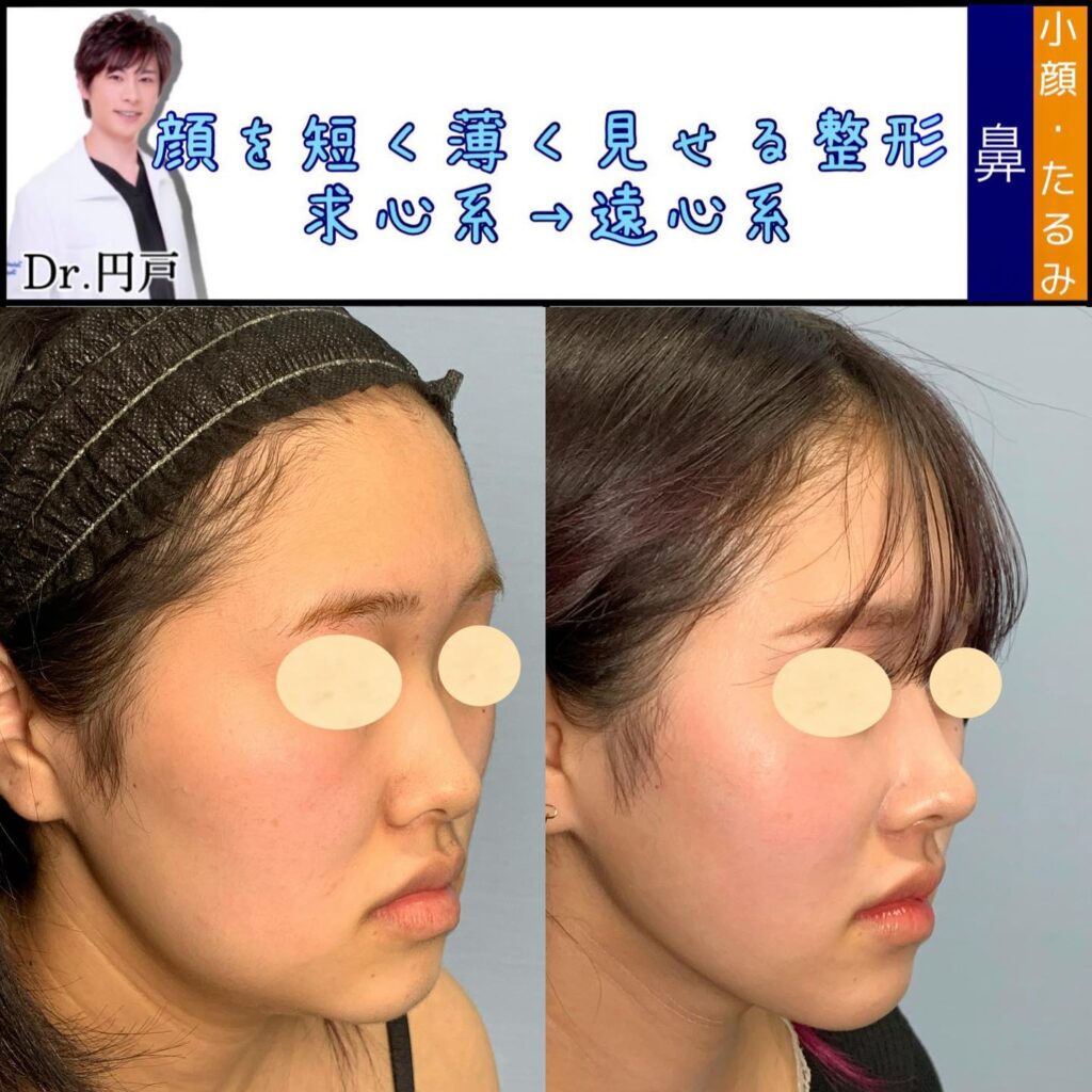 プロテーゼと鼻尖形成と軟骨移植と鼻中隔延長の症例写真 (1)