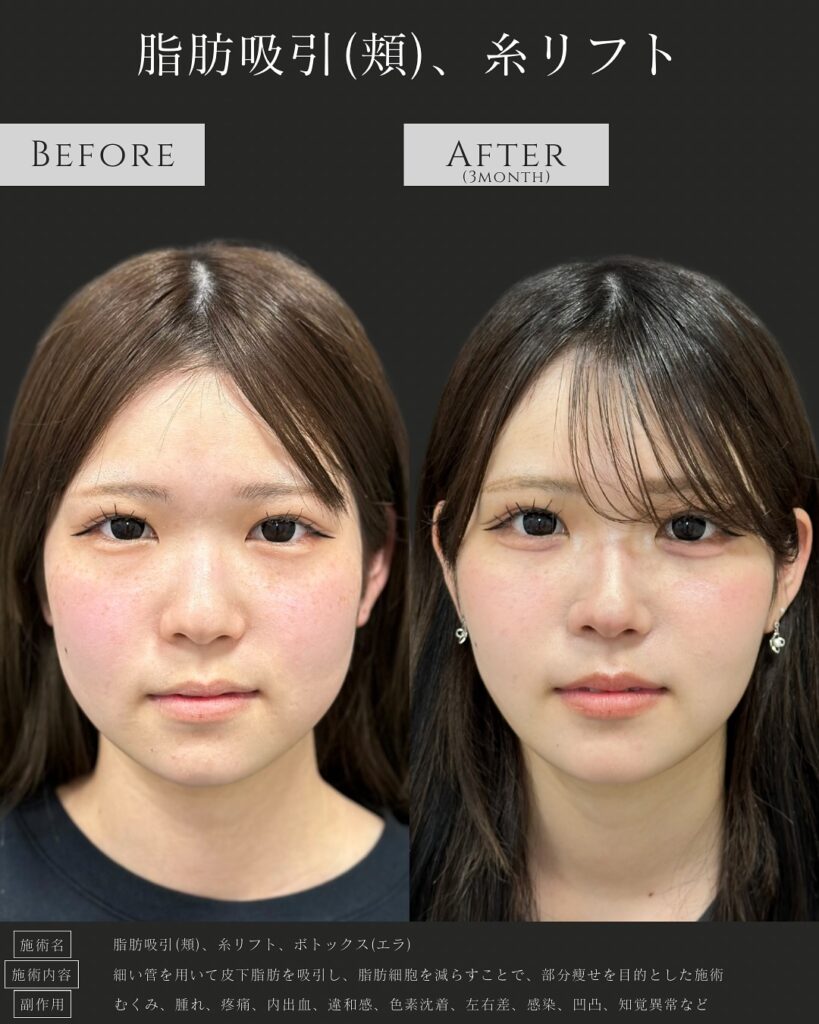 頬の脂肪吸引と糸リフトとエラボトックスの症例写真 (1)
