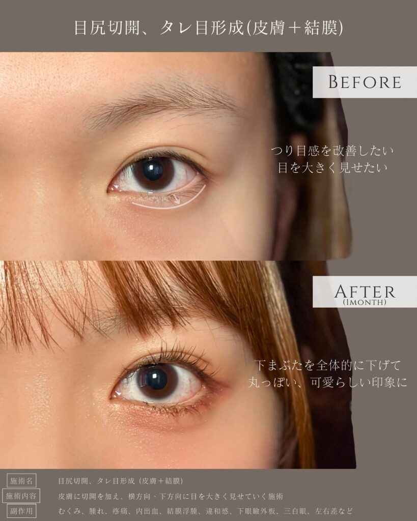 目尻切開とタレ目形成の症例写真 (24)