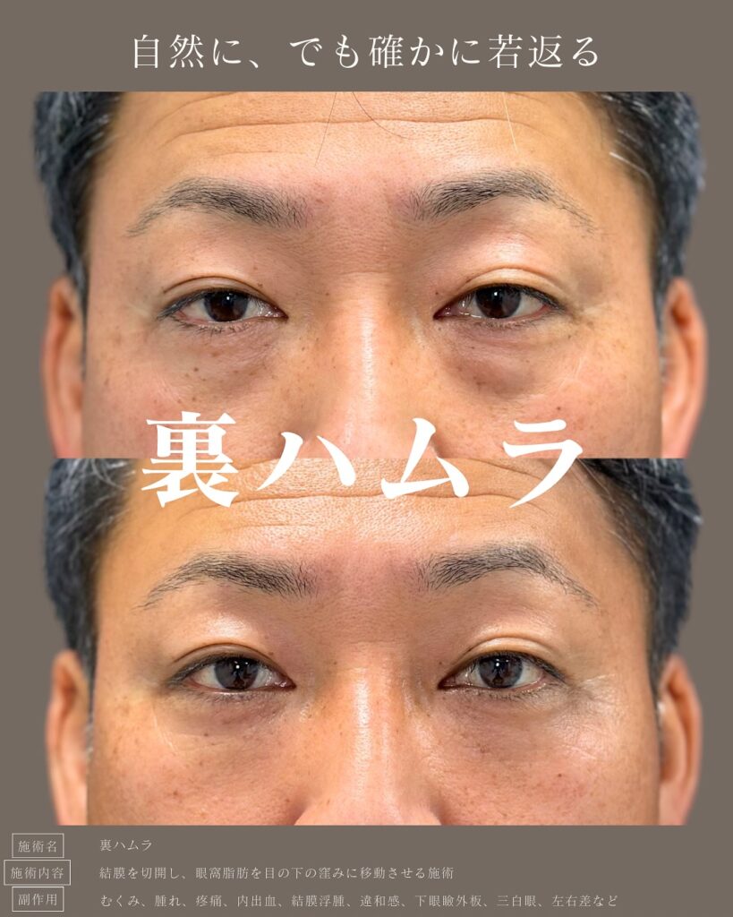 裏ハムラ法を受けた男性の症例写真 (1)