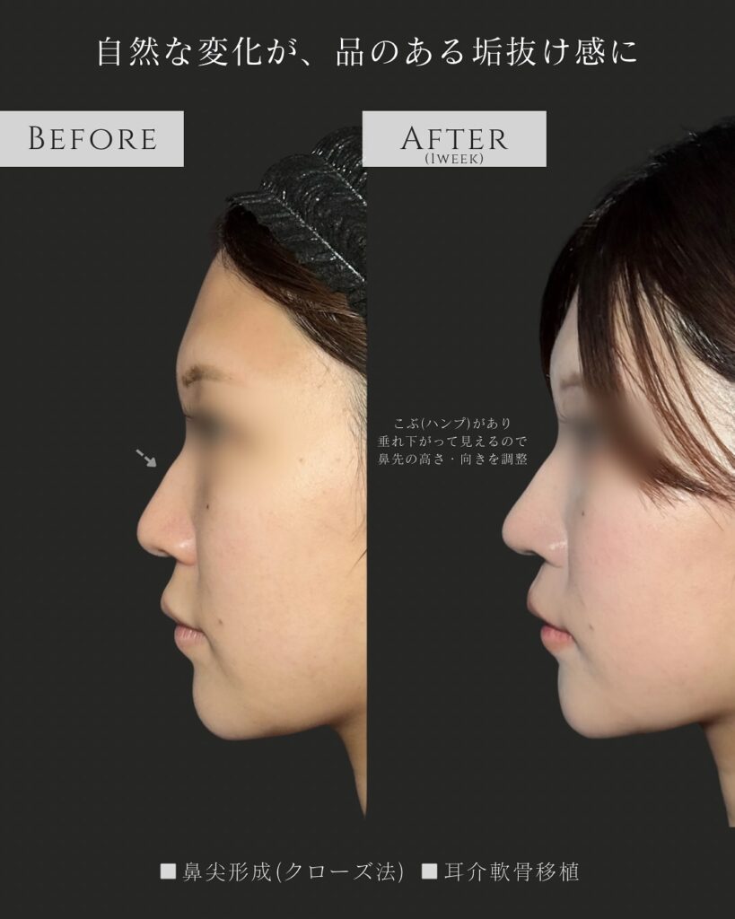 鼻尖形成と耳介軟骨移植の症例写真 (21)