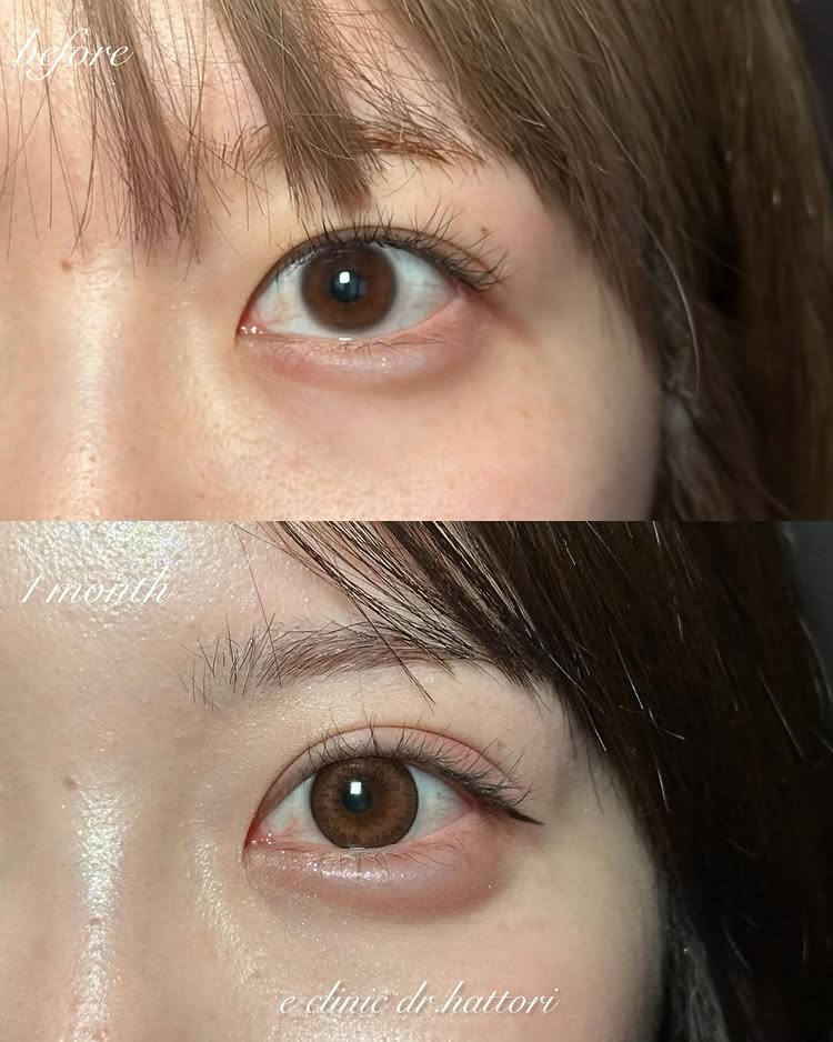 埋没法と涙袋のヒアルロン酸の症例写真 (2)