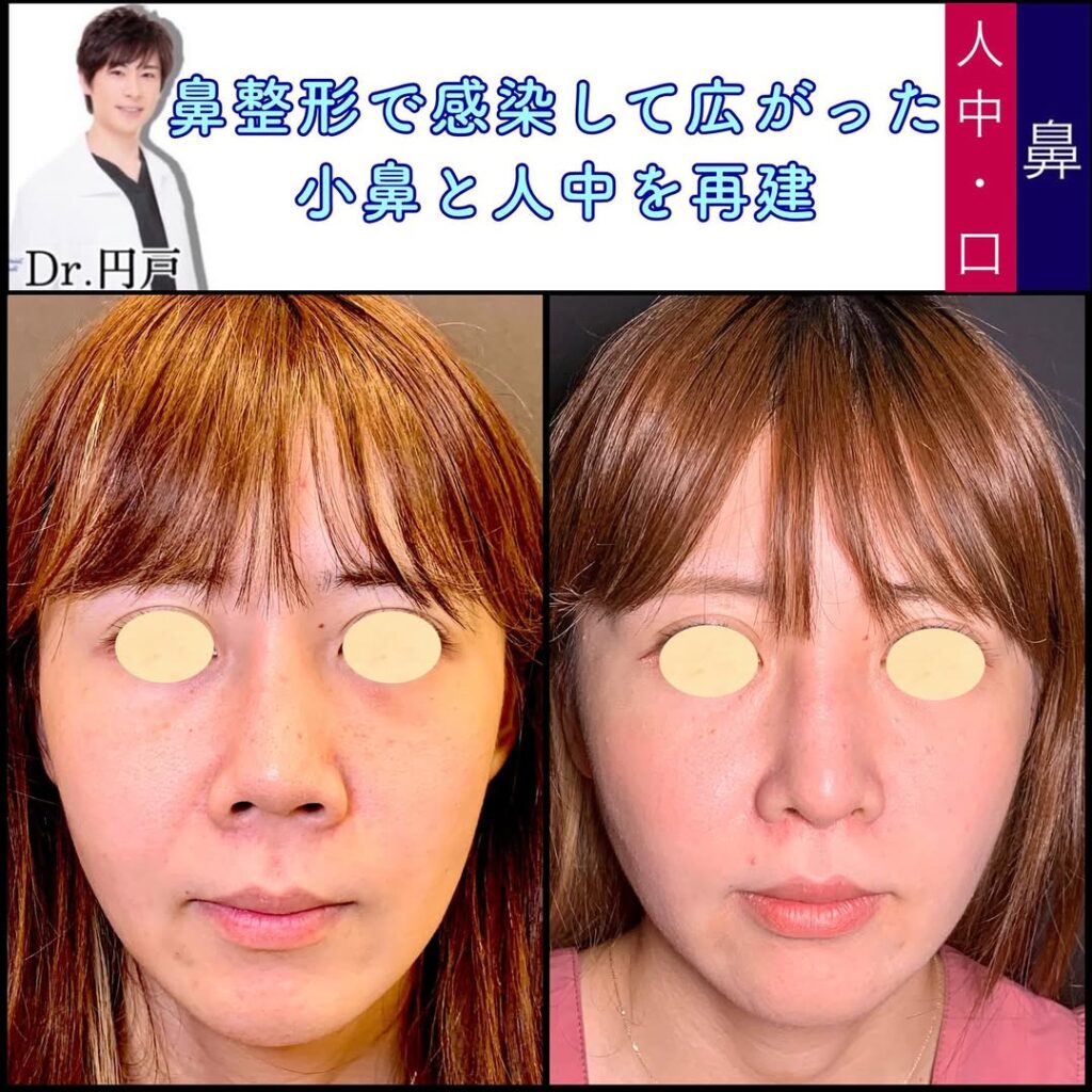 鼻と口の他院修正の症例写真 (2)