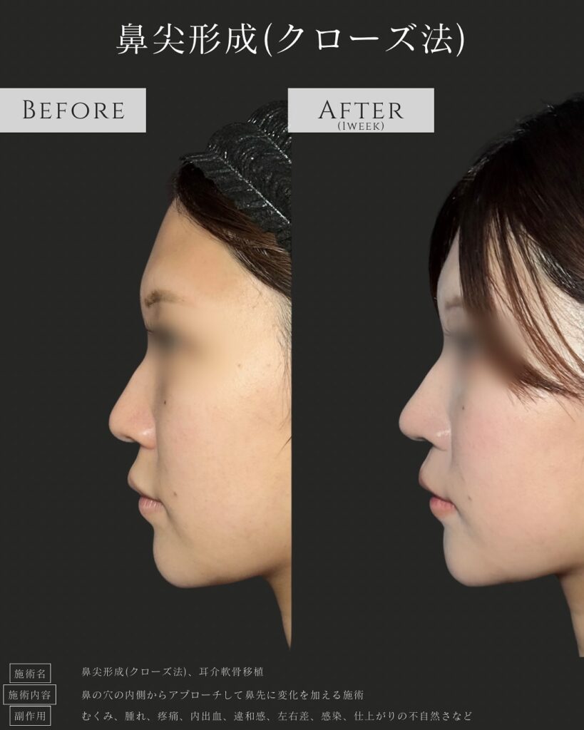 鼻尖形成と耳介軟骨移植の症例写真 (21)