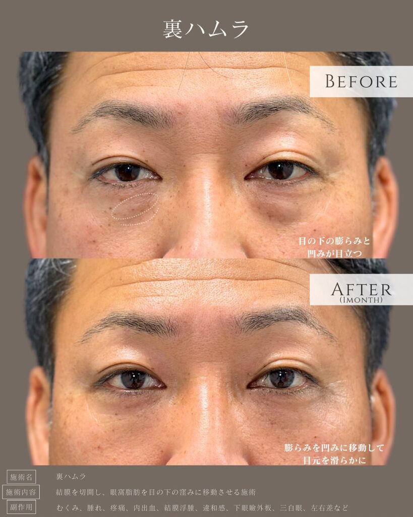 裏ハムラ法を受けた男性の症例写真 (3)