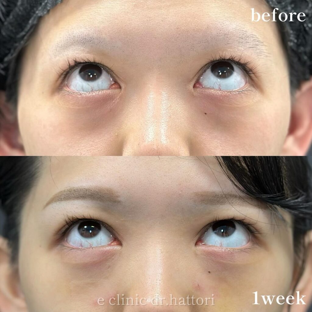 裏ハムラ法の症例写真 (74)