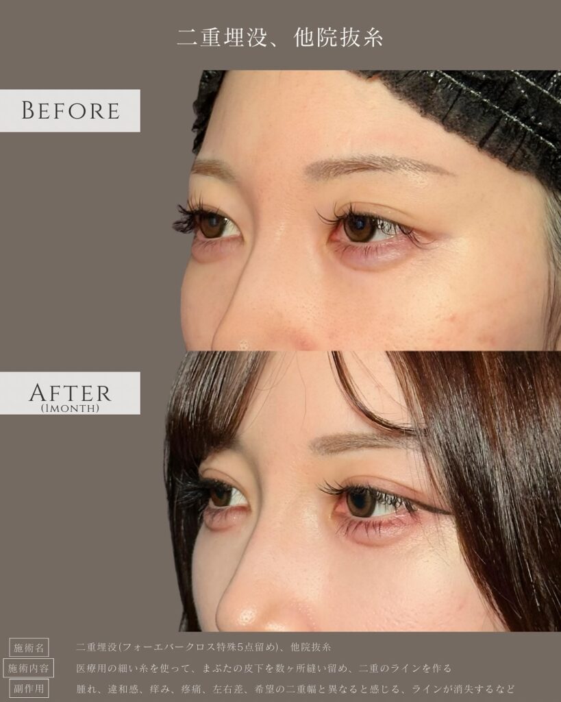 埋没法と他院抜糸の症例写真 (3)