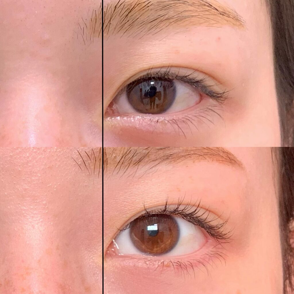 目尻切開と下瞼拡大の症例写真 (4)