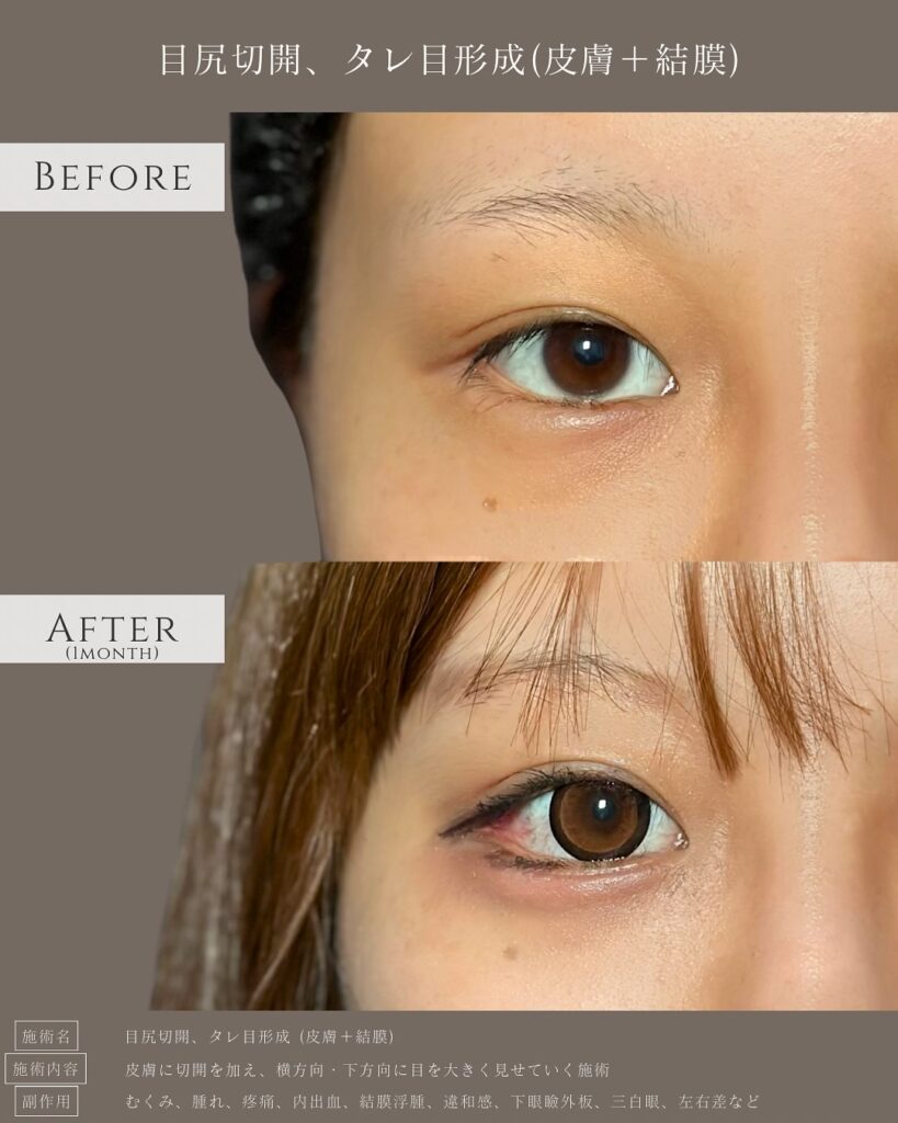 目尻切開とタレ目形成の症例写真 (9)