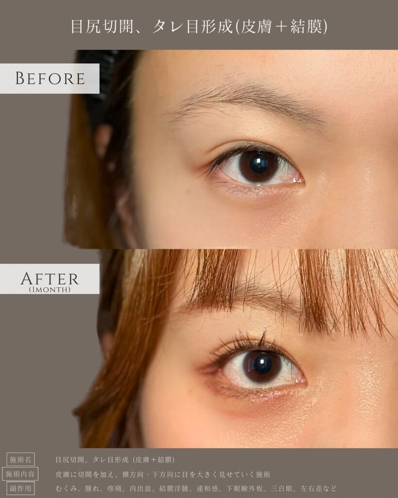 目尻切開とタレ目形成の症例写真 (23)