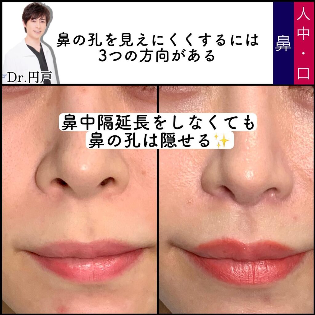 人中短縮と小鼻縮小の症例写真 (2)