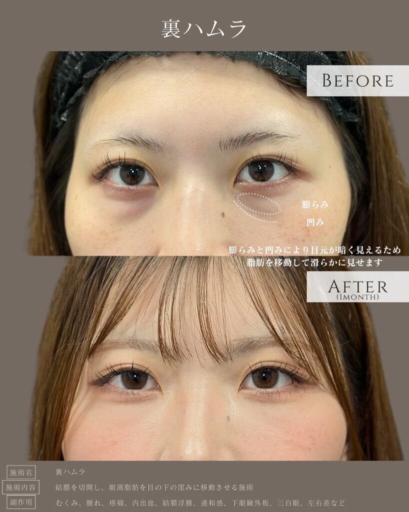 裏ハムラ法の症例写真 (22)