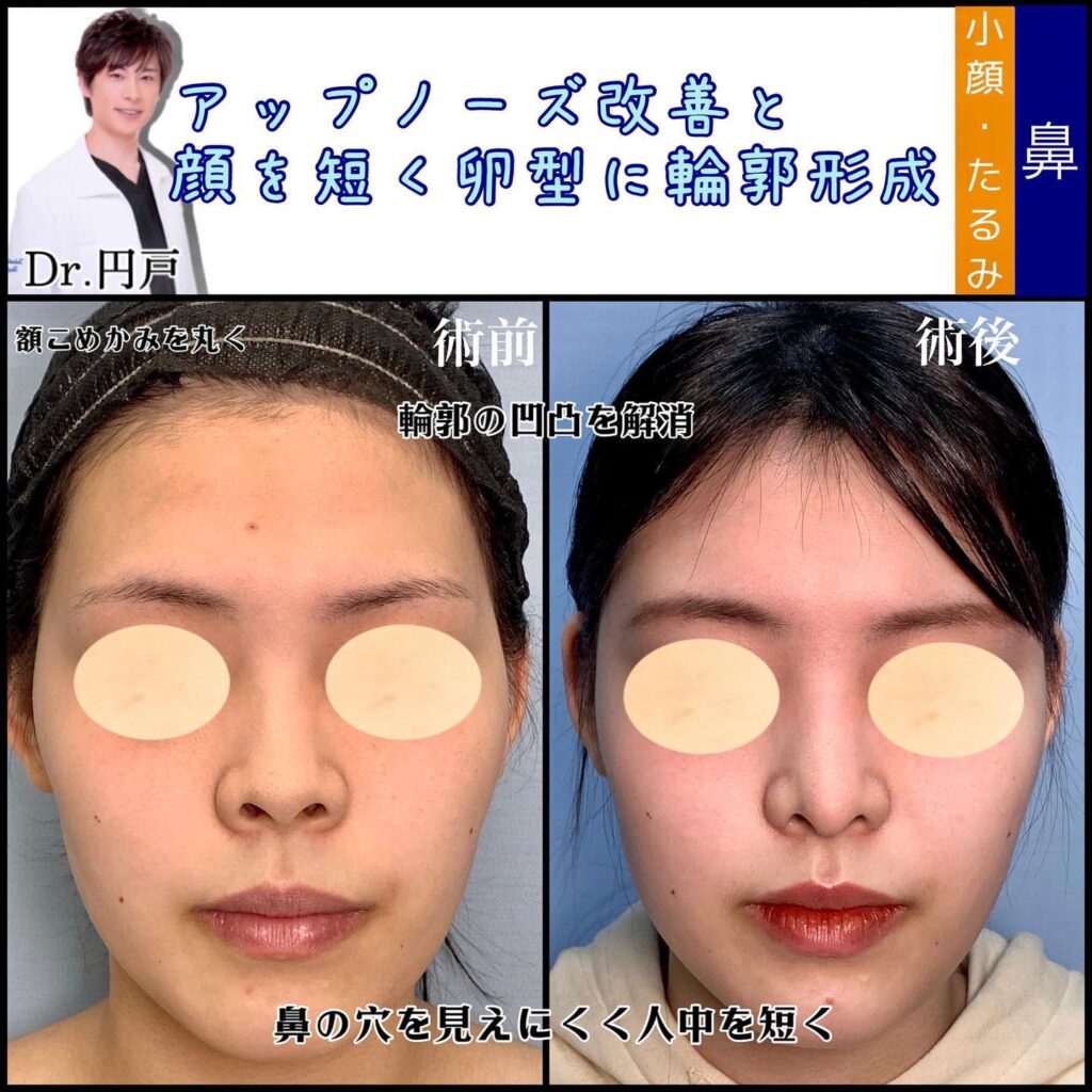 鼻の美容整形と額とこめかみの脂肪注入の症例写真 (1)