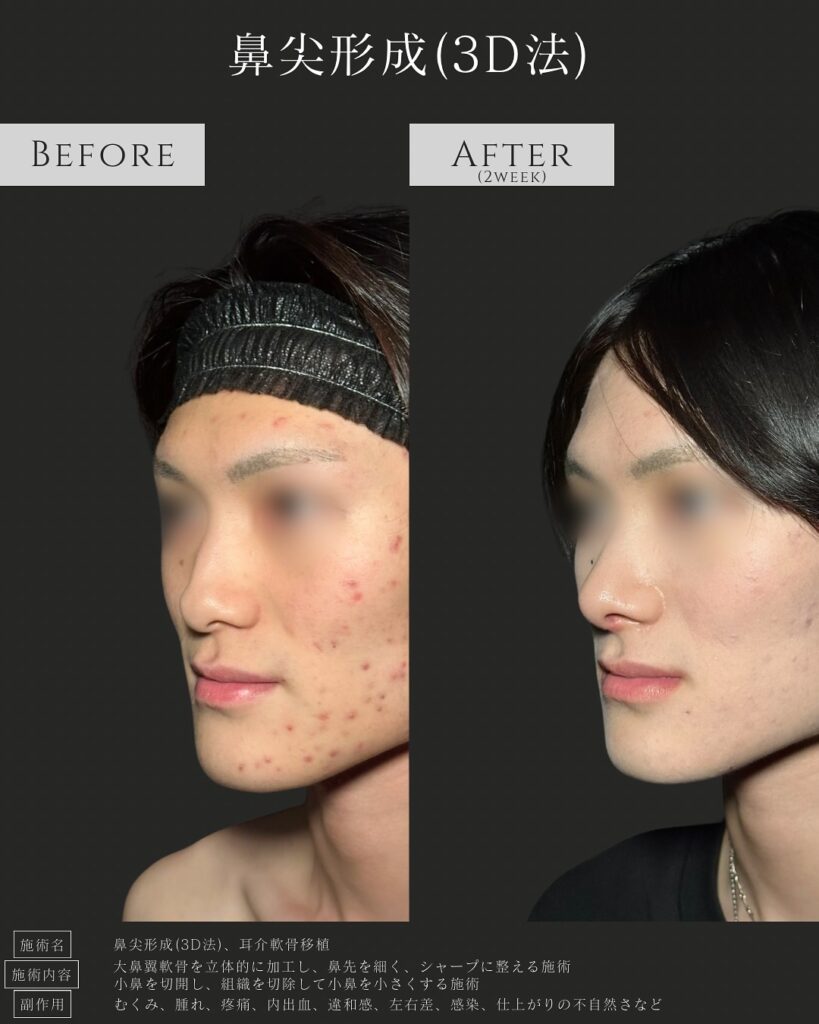 鼻尖形成と耳介軟骨移植の症例写真 (7)