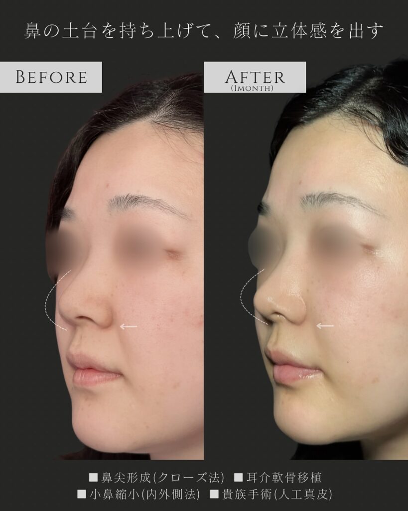 鼻尖形成と耳介軟骨移植と小鼻縮小と貴族手術の症例写真 (8)
