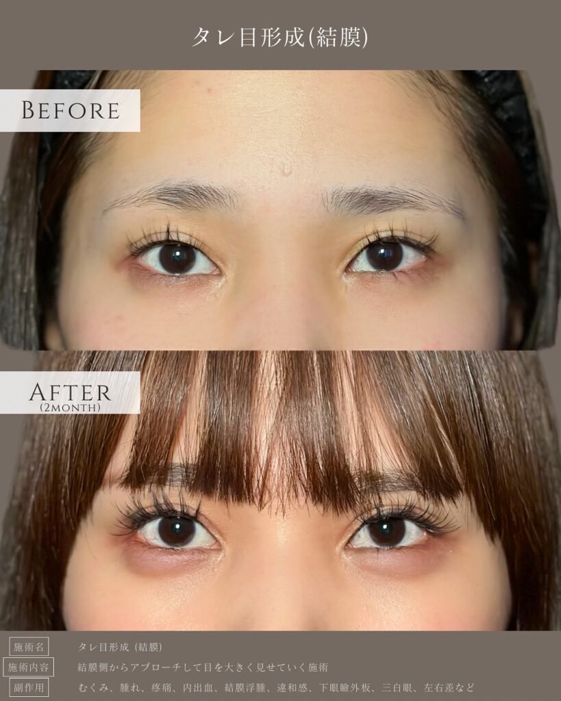 タレ目形成の症例写真 (17)