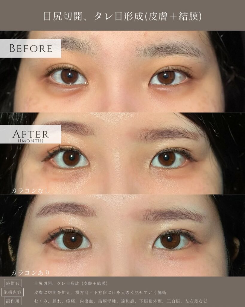 目尻切開とタレ目形成の症例写真 (36)