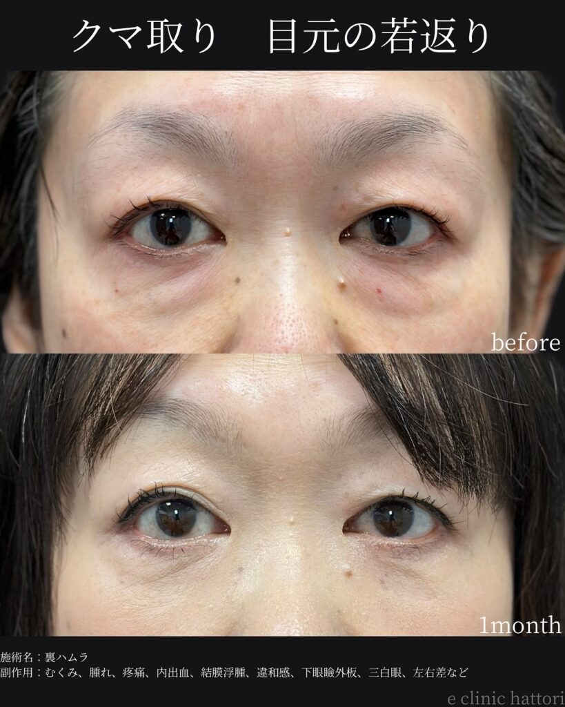 裏ハムラ法の症例写真 (52)