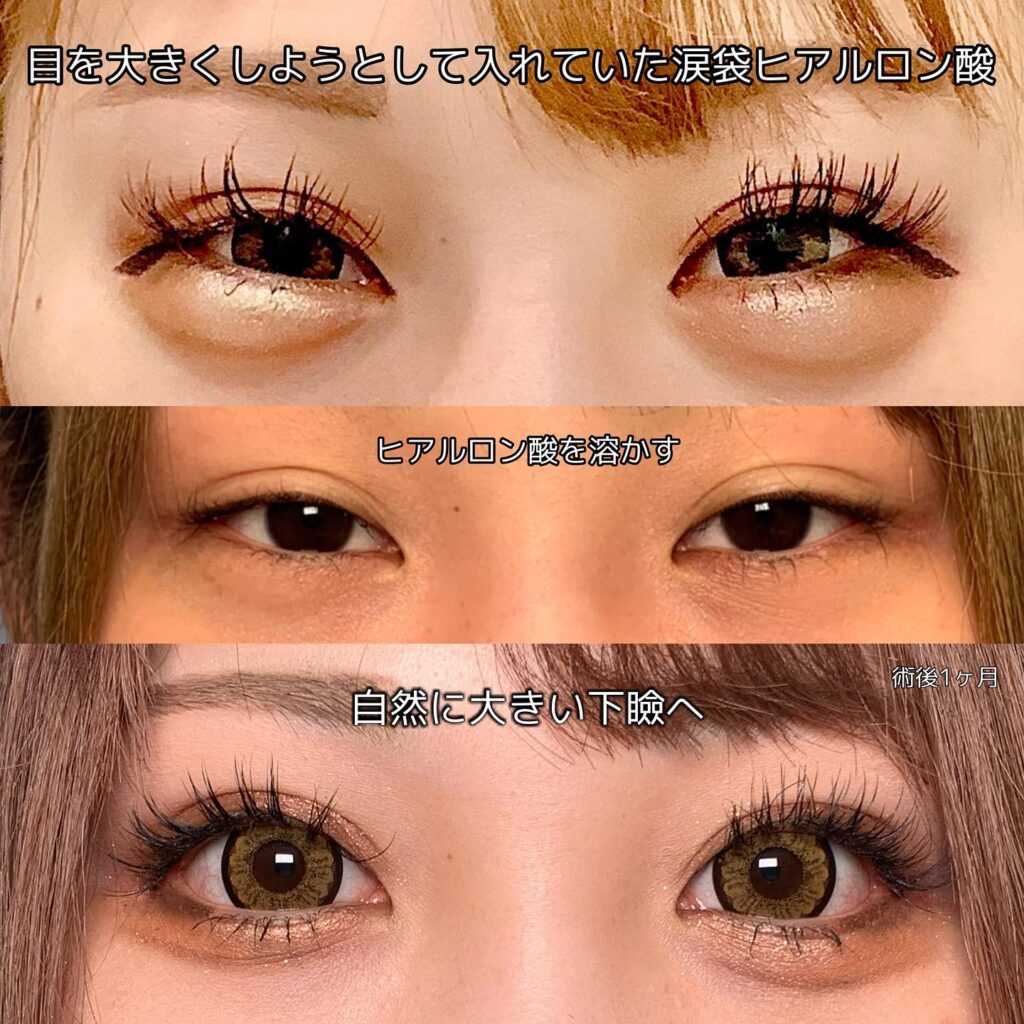 目尻切開、タレ目(グラマラス)形成の症例写真