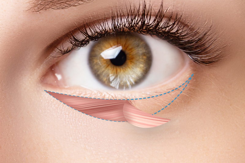 タレ目形成の図解（皮膚側切開）