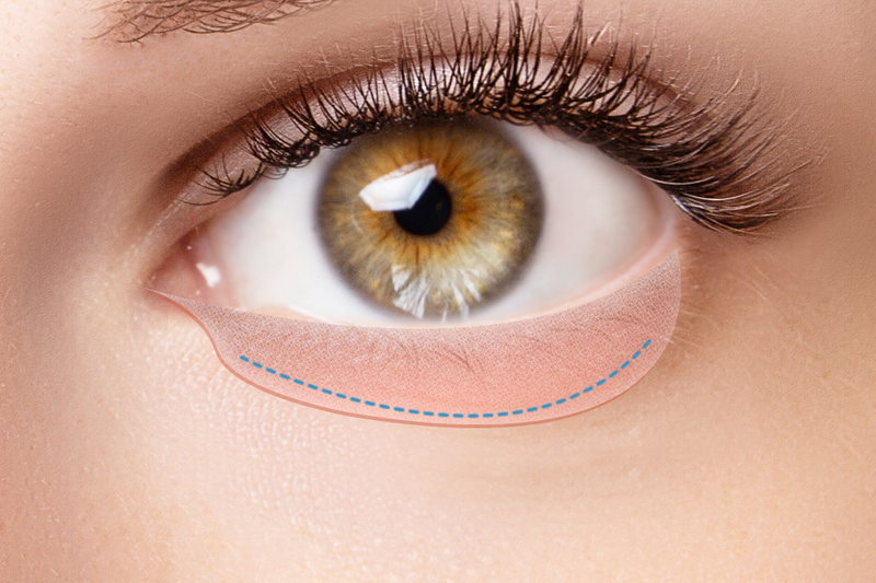 タレ目形成の図解(結膜側切開）