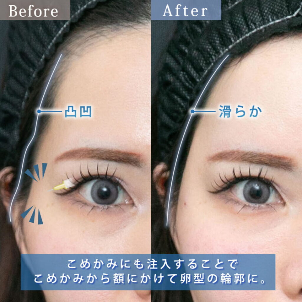 額とこめかみにヒアルロン酸を注入した症例写真
