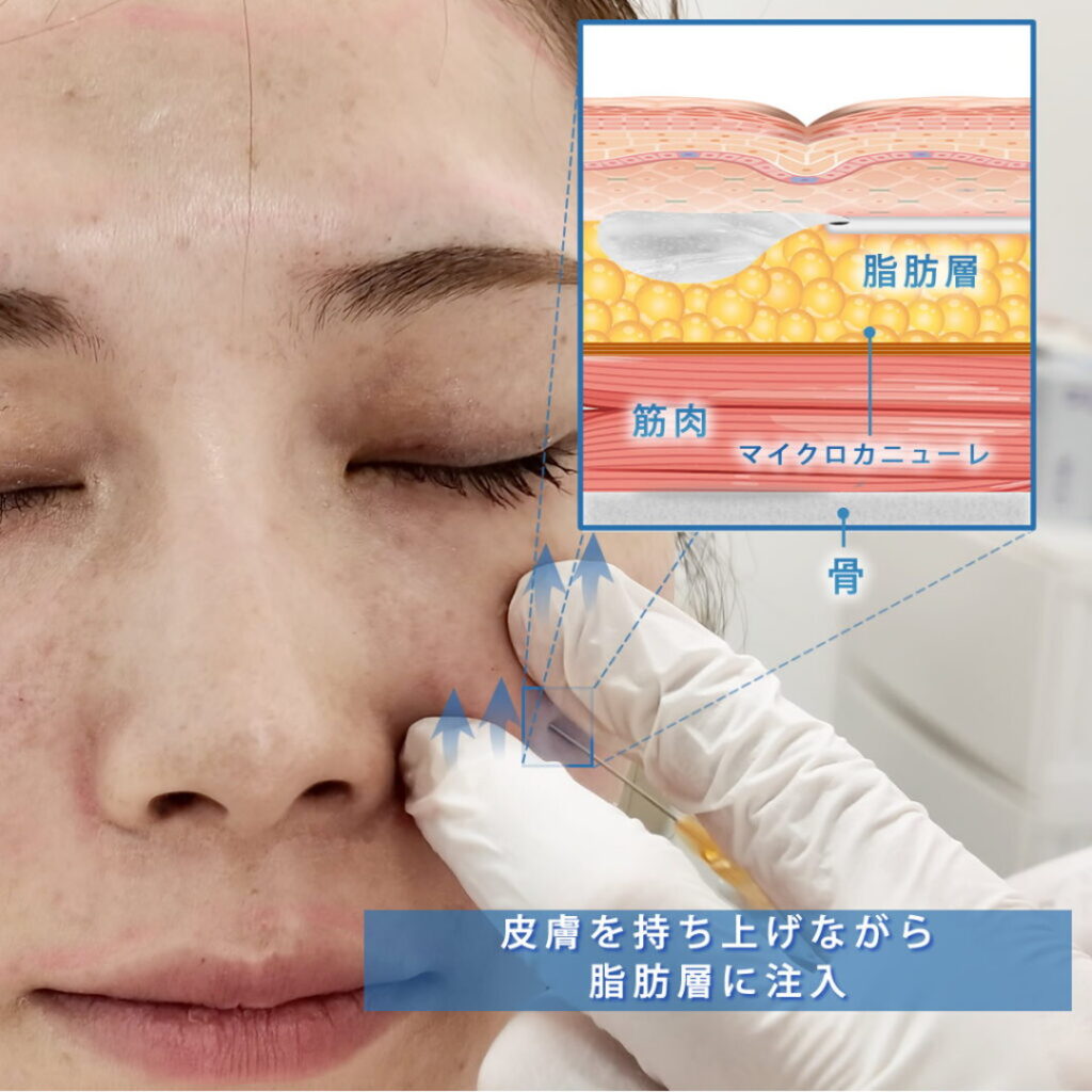 頬のコケにヒアルロン酸を注入している図解