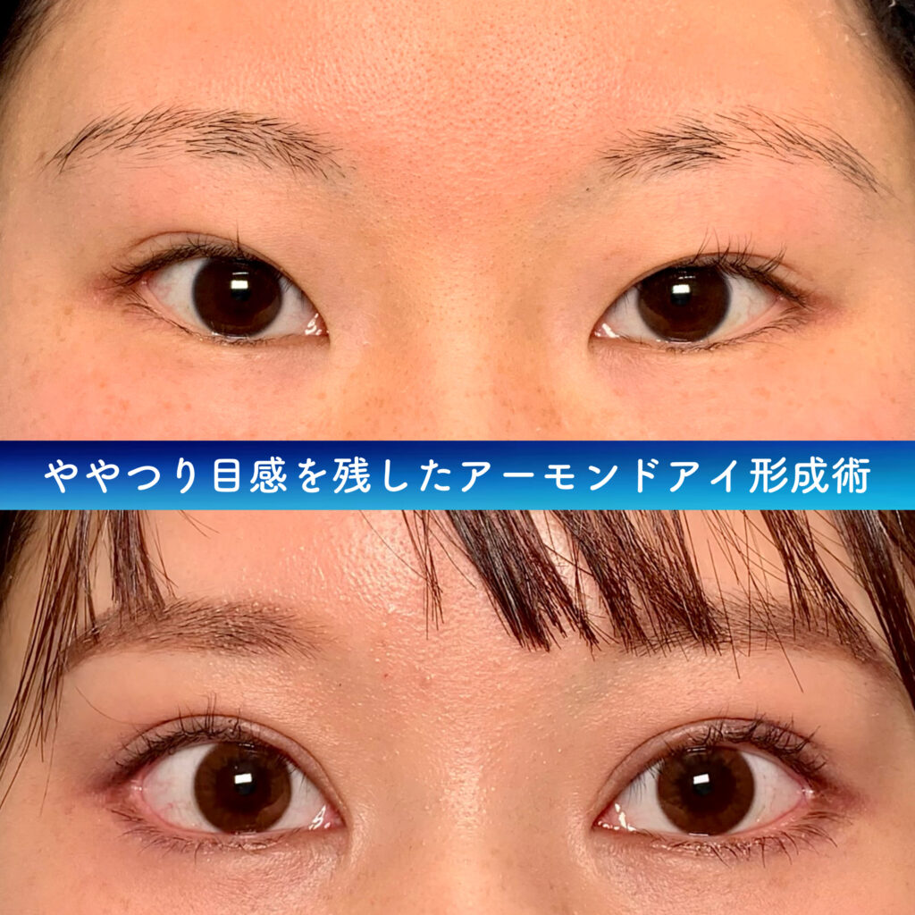 アーモンドアイ形成の症例写真