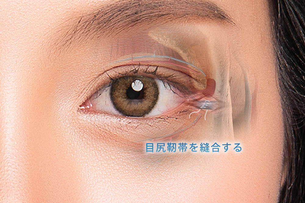 目尻靭帯移動術の縫合の図解