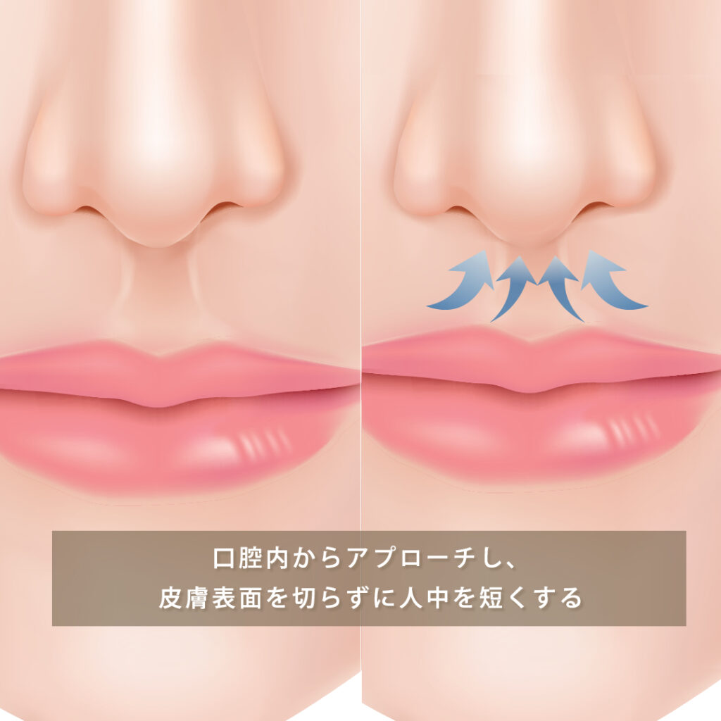 人中短縮手術（粘膜切開法）の図解