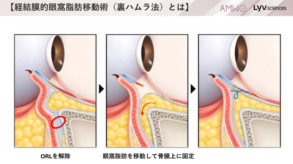 9_経結膜的眼窩脂肪移動術（裏ハムラ法）とは