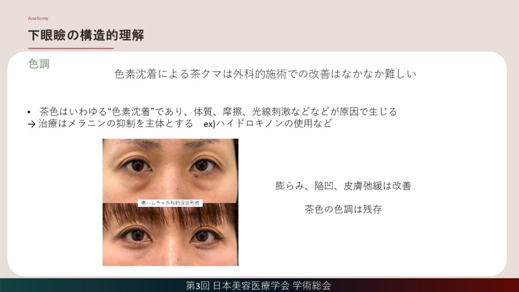 13_色素沈着による茶クマは外科的施術での改善はなかなか難しい