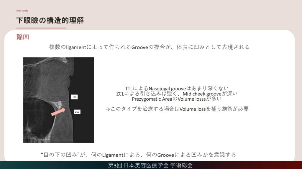 7_下眼瞼の構造的理解(陥凹)