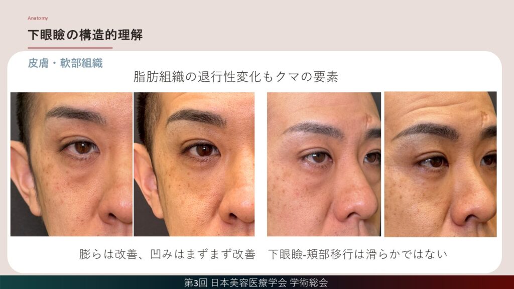 12_提案術式は裏ハムラ+脂肪注入の症例2